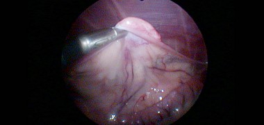 Endoskopische Kastration
