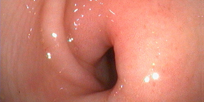 Gastroskopie Übergang Magen-Darm