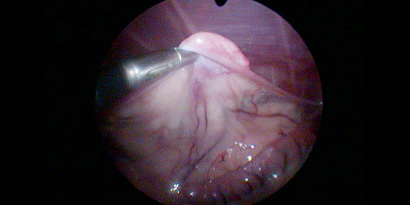 Endoskopische Kastration